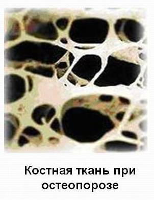 Костная ткань при остеопорозе.jpg